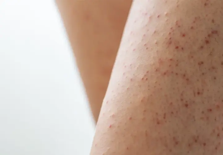 Närbild på ben med keratosis pilaris, små röda prickar som ger en knottrig hudtextur.