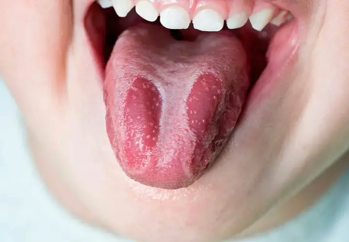 Lengua geográfica con parches blancos y rosados, como un mapa de sabores.