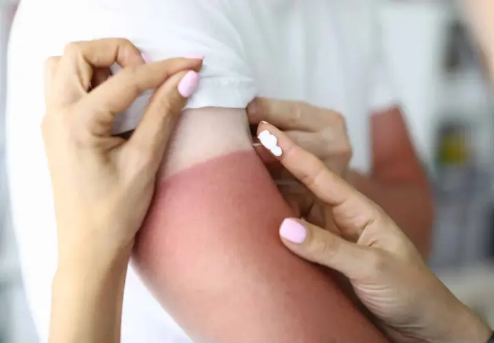 Application de crème pour désinfecter une brûlure solaire sur un bras rouge.