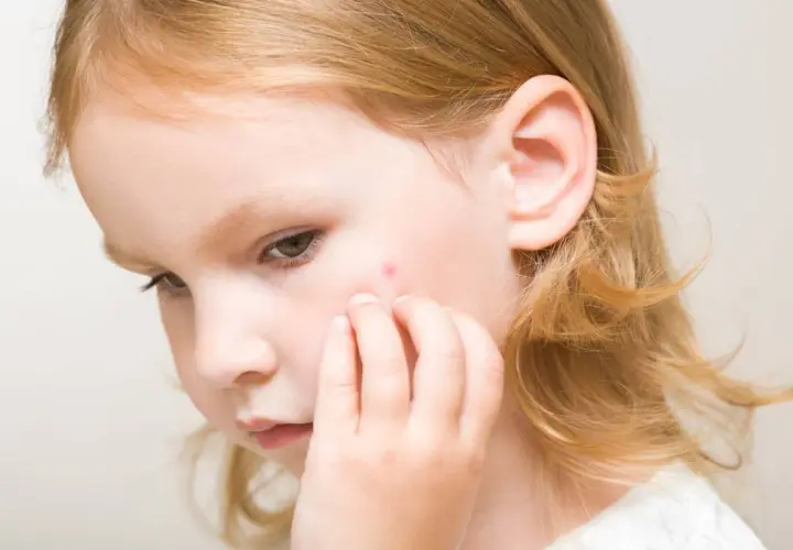 Niña con una pequeña lesión roja en la mejilla, posible signo de impétigo en niños.