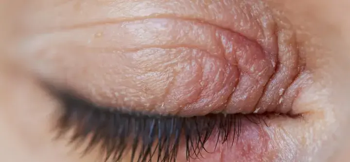 Gros plan sur un œil fermé, montrant la peau ridée et sèche de la paupière, signe d'une irritation paupière.