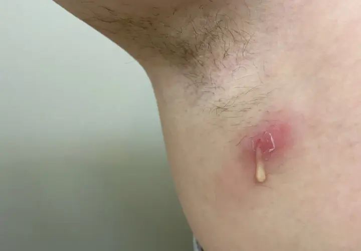 Ropień pod pachą, widoczny ropień po angielsku, z wydzielającą się żółtawą treścią.