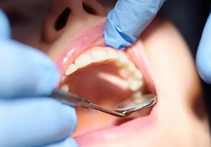 Dentysta bada zęby, szukając oznak próchnicy wtórnej.
