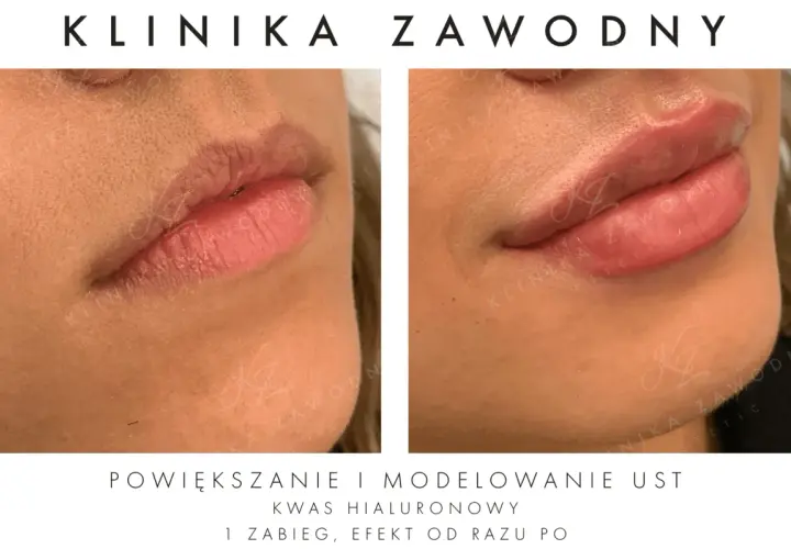 Kwas hialuronowy na usta: Nawilżenie czy powiększanie? Poznaj prawdę