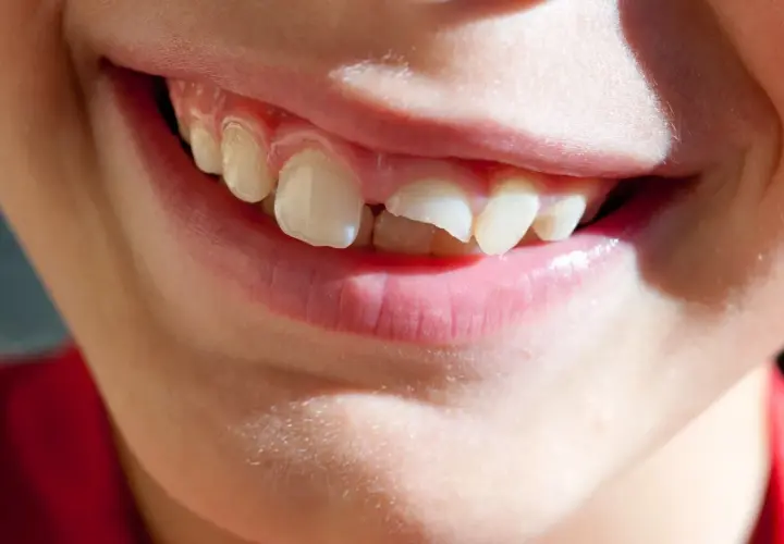 Sorriso di bambino con un dente spezzato, un piccolo incidente che non ferma la gioia.