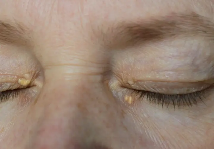 Párpados con xantelasma, depósitos amarillentos de colesterol cerca de los ojos.