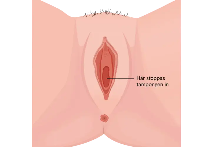 Illustration av underlivet som visar en eventuell obalans i underlivet efter samlag. Texten indikerar var tampongen förs in.