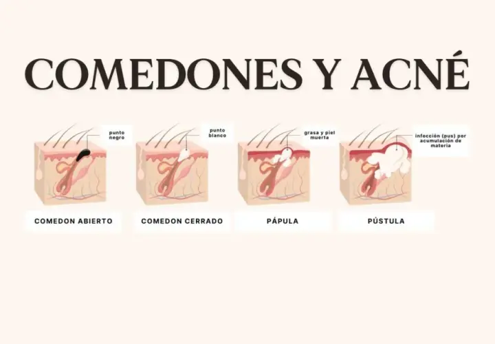 Ilustración de la piel mostrando un punto negro enquistado, un punto blanco, pápula y pústula, explicando el acné.