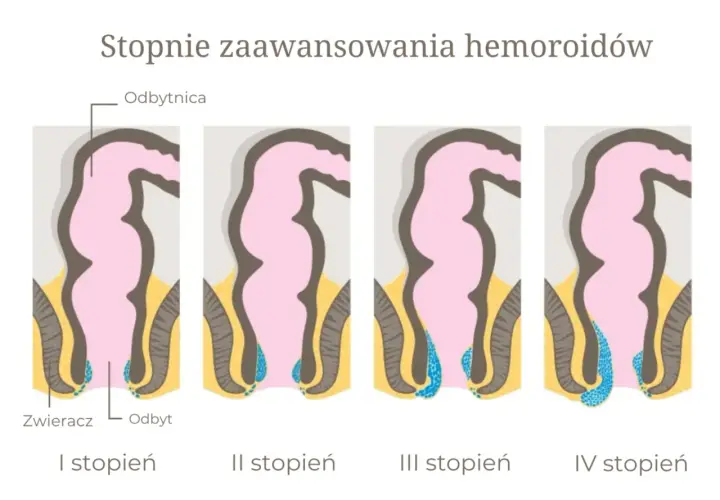 Ilustracja przedstawia cztery stopnie zaawansowania żylaków odbytu, od I do IV, pokazując ich stopniowe powiększanie się.