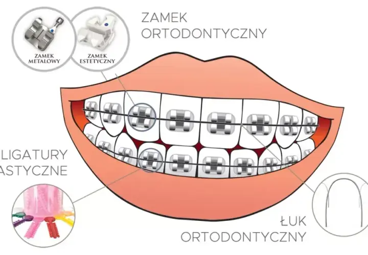 Jak działa aparat na zęby? Odkryj sekrety prostego uśmiechu!