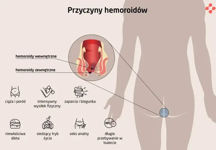 Ilustracja przedstawia przyczyny hemoroidów: ciąża, wysiłek fizyczny, zaparcia, dieta, siedzący tryb życia, seks analny, długie przebywanie w toalecie.
