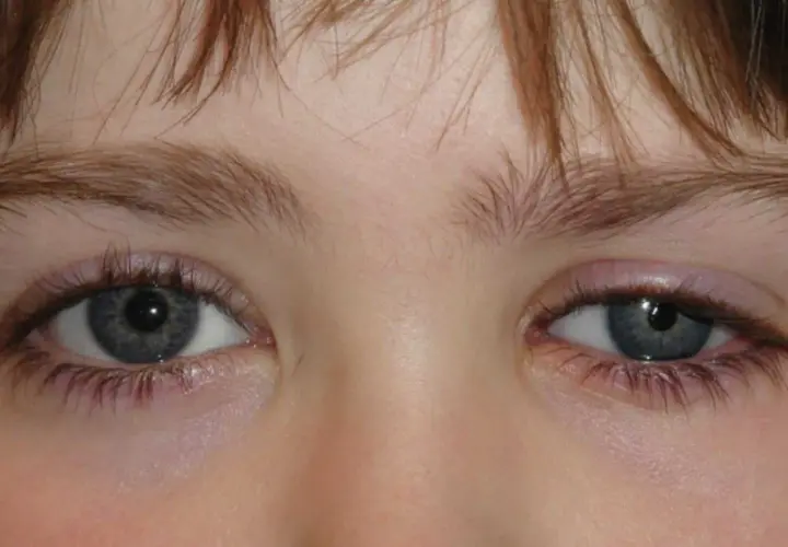 Ojos hundidos de un niño, con pestañas largas y cejas finas.