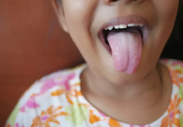 Niña saca la lengua, mostrando una capa blanca. Podría necesitar remedios caseros para la lengua blanca.