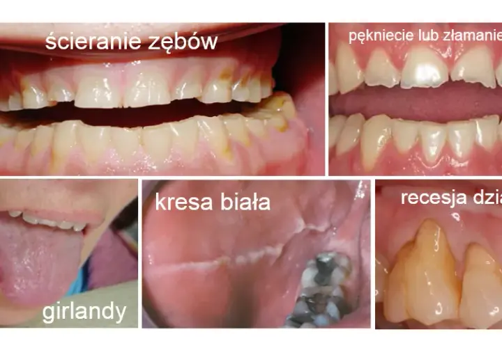 Płacz i zgrzytanie zębów: Czy bruksizm niszczy Twoje zęby?