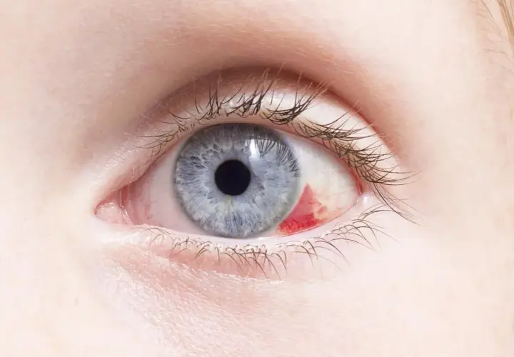 Ojo azul con hemorragia subconjuntival. Parece un bebé con ojos rojos por fuera, pero es un adulto.