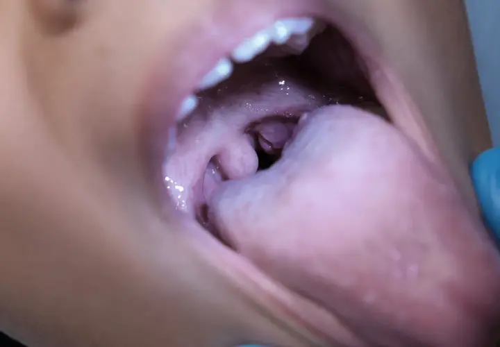 Vista ravvicinata della bocca aperta, con la lingua che mostra un rigonfiamento e arrossamento, indicativo di un ascesso palato.