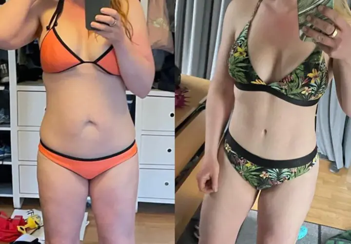 Före och efterbilder visar en kvinnas mage före och efter en full bukplastik.