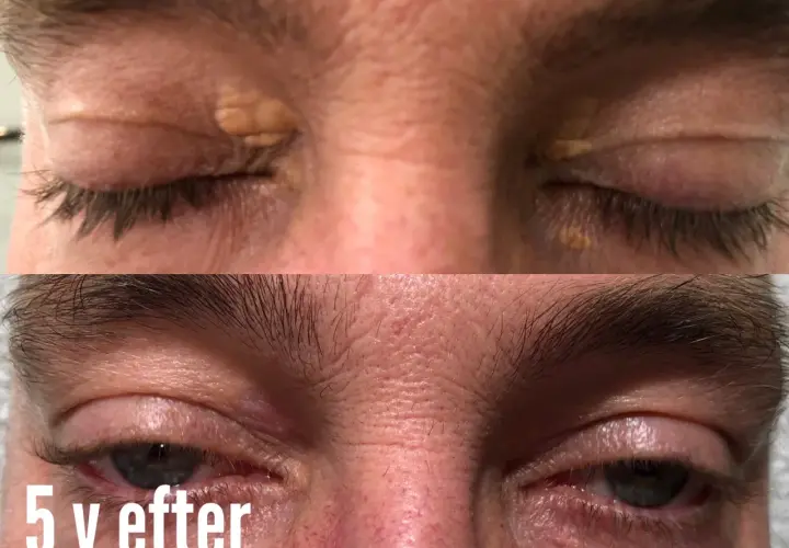 Före- och efterbilder som visar hur xantelasma har behandlats.