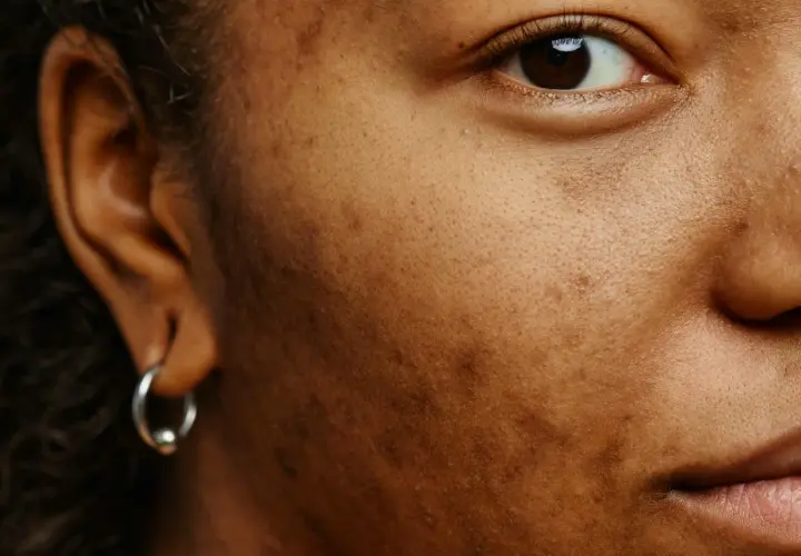 Närbild på ett ansikte med melasma. Örat med en silverring syns till vänster, och en del av ögat och munnen till höger.
