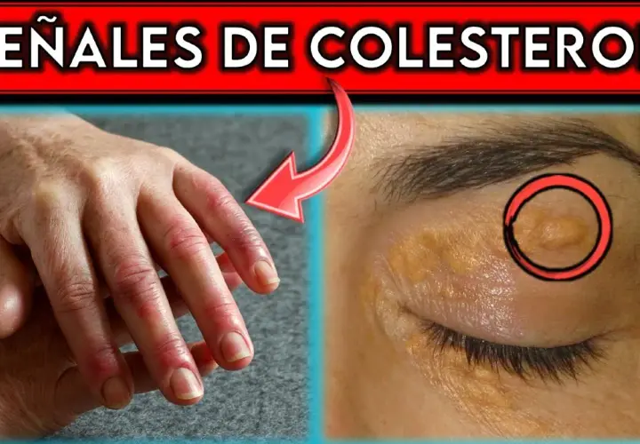 Síntomas de colesterol alto: ¿estás ignorando señales preocupantes?
