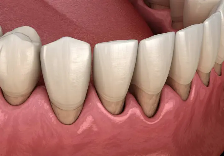 Dientes sanos y encías rosadas. Ilustración que muestra cómo tratar periodontitis para recuperar la salud bucal.