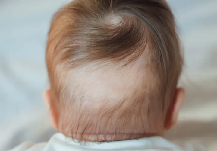 Dettaglio della nuca di un neonato con capelli castani e una chiazza di piebaldismo, dove i capelli sono più chiari.