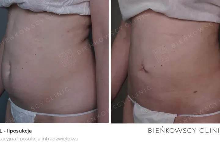 Liposukcja: Co to? Metody, efekty, rekonwalescencja. Czy to dla Ciebie?
