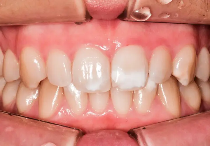 Denti con macchie bianche, possibili segni di carie iniziale.