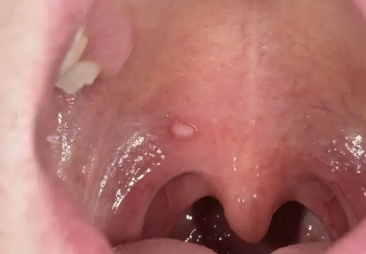 Objawy HPV w jamie ustnej: Jak rozpoznać i uniknąć poważnych problemów