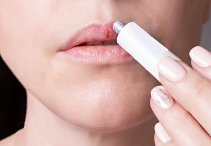 Persona aplica crema en un labio con un afta labial.