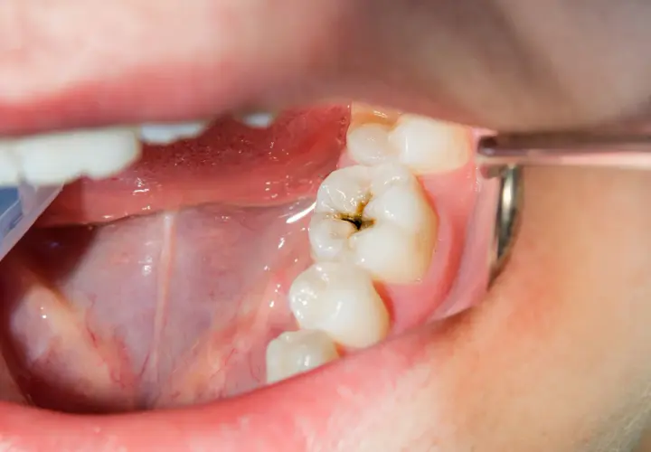 Vista de cerca de una boca con un diente que muestra caries debajo de la encía.