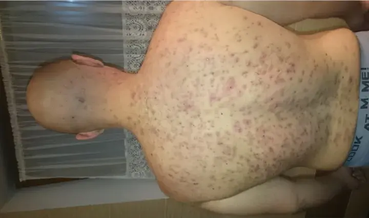 Jak skutecznie leczyć pryszcze po sterydach i odzyskać zdrową skórę