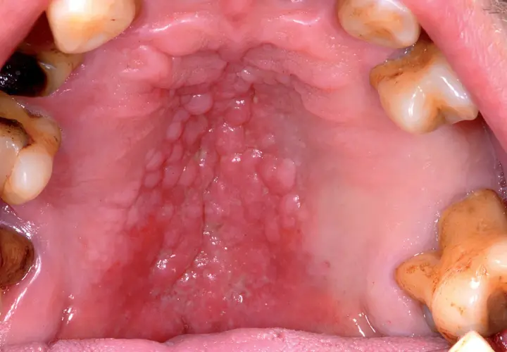 Dettaglio dell'interno bocca con palato arrossato e noduli, circondato da denti.