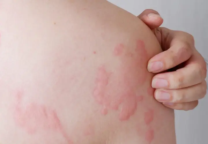 Pelle con pomfi rossi e pruriginosi, tipici dell'orticaria. Potrebbe essere un caso di orticaria bambini, che richiede attenzione.