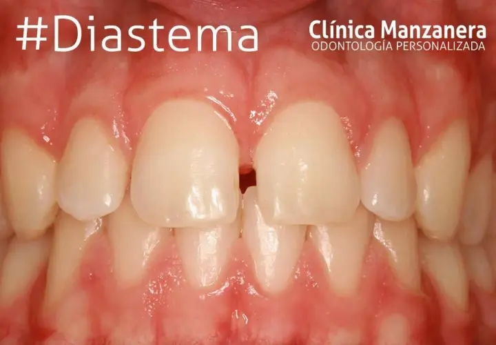 Primeros planos de dientes con un espacio visible entre los incisivos centrales superiores, un ejemplo de brackets dientes separados.