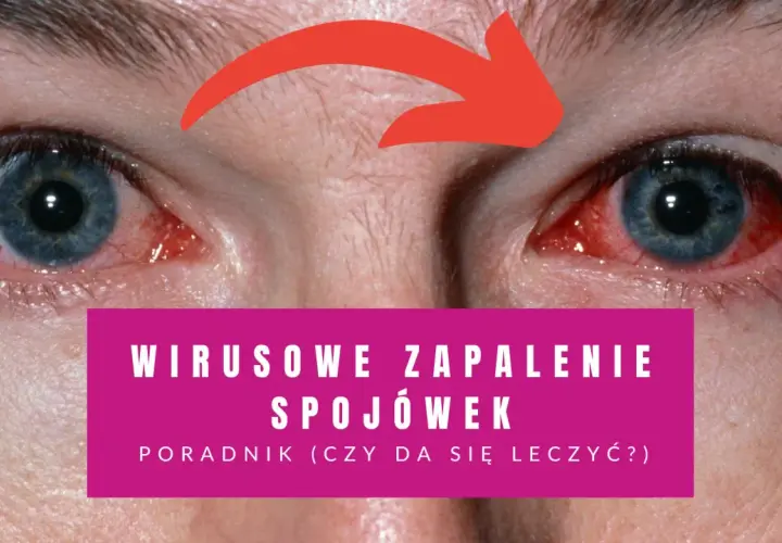 Czerwone, podrażnione oczy z widocznymi naczynkami. Napis: "Wirusowe zapalenie spojówek - poradnik".