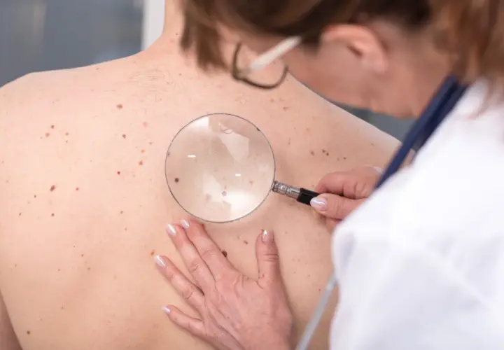 Dermatolog bada liczne znamiona na plecach pacjenta za pomocą lupy.