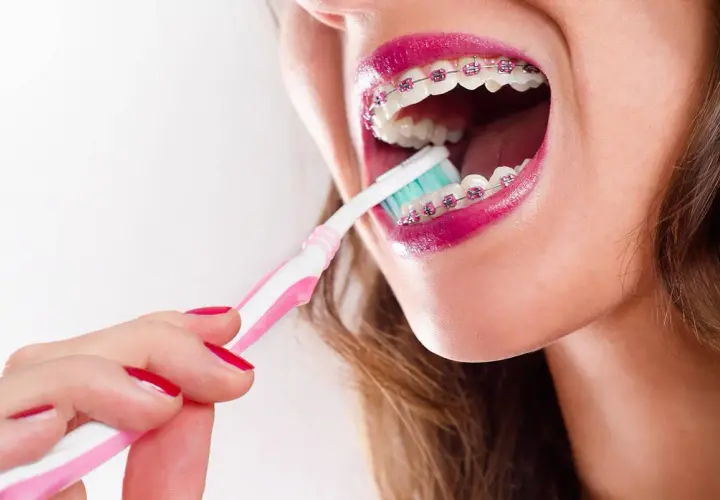 Mujer cepillando sus brackets transparentes con un cepillo rosa y blanco.