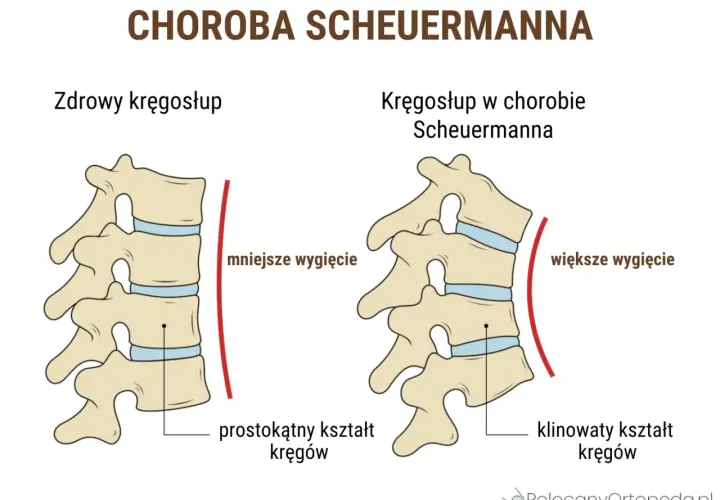Porównanie kręgosłupa zdrowego i w chorobie Scheuermanna u dorosłych. Widoczne klinowate kręgi i większe wygięcie kręgosłupa.
