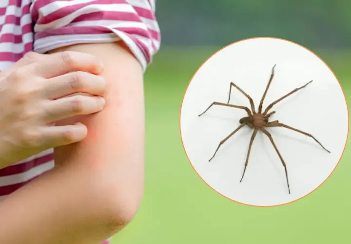 Brazo con erupción roja y picazón, junto a una araña marrón. Aprende cómo curar picadura de araña.