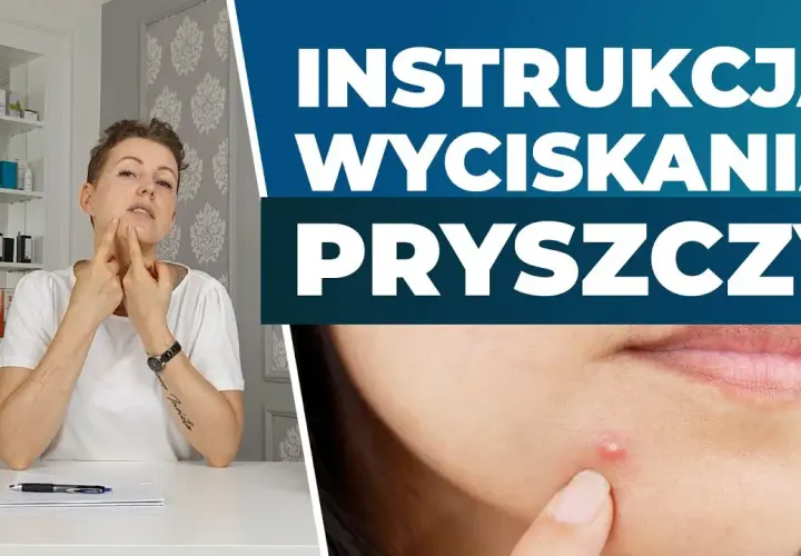 Pryszcze: Wyciskać czy nie? Poradnik eksperta i "trójkąt śmierci"