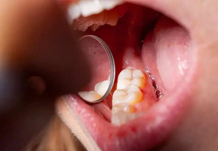 Widok jamy ustnej z widocznymi zębami i lustrem dentystycznym. Na zębach widoczne są oznaki demineralizacji szkliwa, co może prowadzić do próchnicy.
