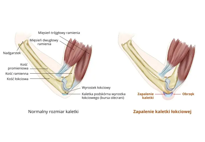 Ilustracja porównuje zdrowy łokieć z zapaleniem kaletki łokciowej. Widać obrzęk i płyn w łokciu po prawej stronie.