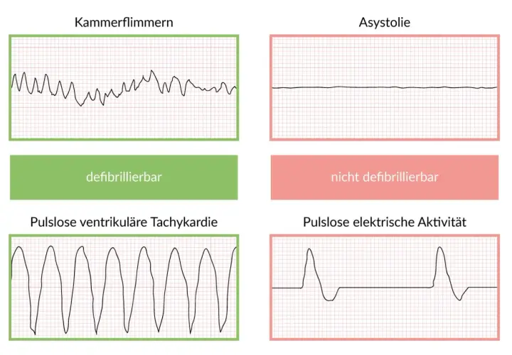 EKG-Kurven: Kammerflimmern & pulslose ventrikuläre Tachykardie (defibrillierbar) vs. Asystolie & pulslose elektrische Aktivität (nicht defibrillierbar). Wichtig für Lebenserwartung nach Reanimation.