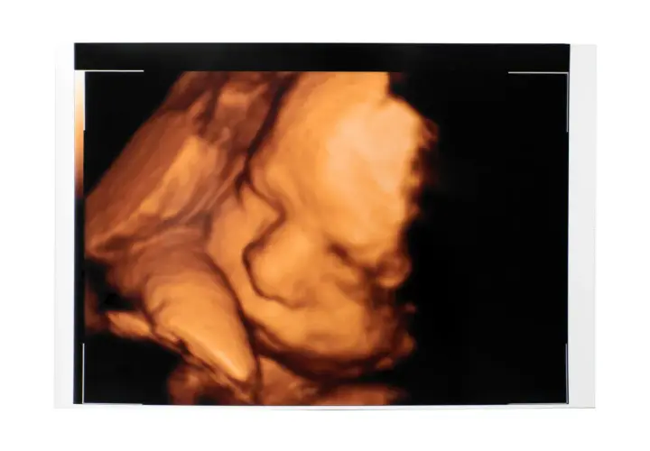 Ecografia 3D di un feto. Il profilo del bambino è ben visibile, con la bocca e il naso definiti. Dopo la morfologica si può stare tranquilli.