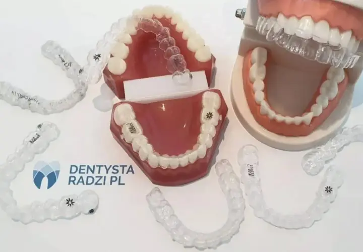 Modele szczęk z aparatami ortodontycznymi. Rozwiązanie dla dorosłych z krzywymi zębami.
