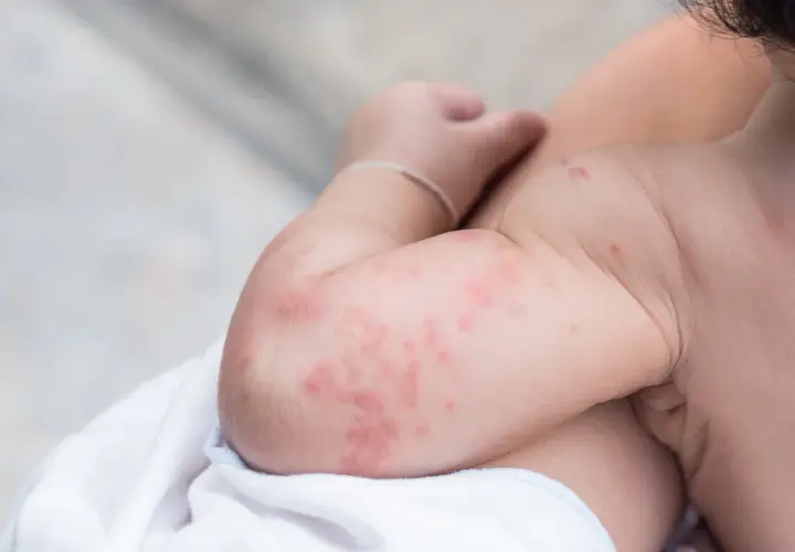 Braccio di un bambino con chiazze rosse e pruriginose, indicative di eczema sulla pelle.