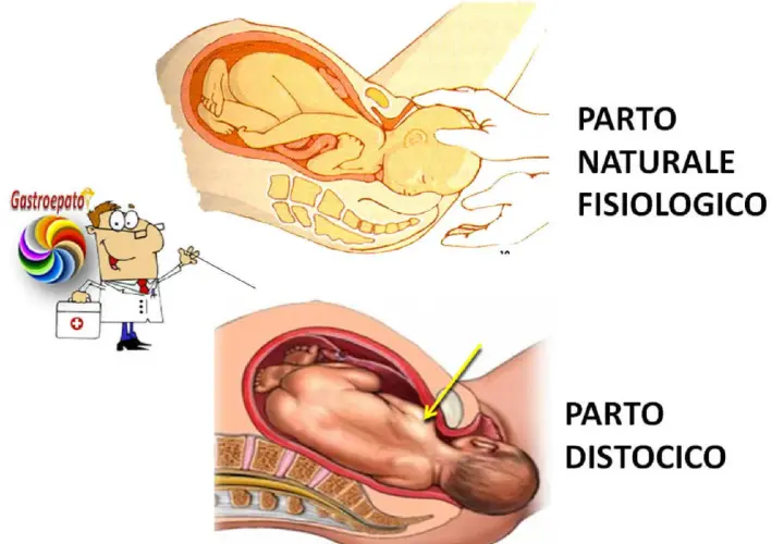 Illustrazione di un parto naturale fisiologico e di un parto distocico, dove il bambino è in posizione anomala.