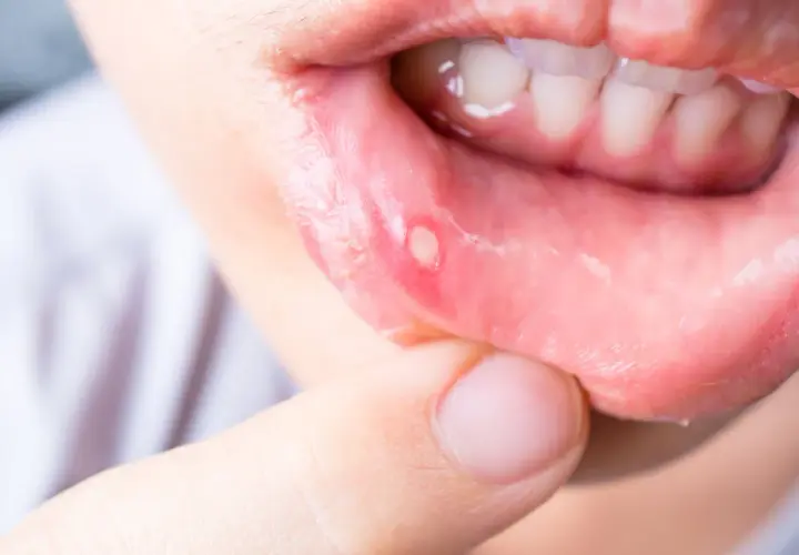L'immagine mostra una vescicola dolorosa sulla mucosa labiale, tipica della stomatite erpetica. Quanto dura? Solitamente una settimana.