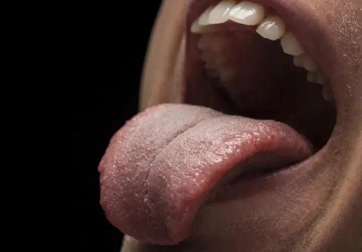 Primer plano de una boca abierta mostrando la lengua rosada con un bulto blanco en la lengua.